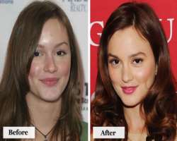 Leighton Meester before surgery